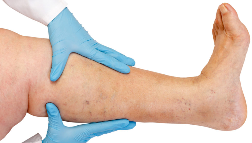 How-to-recognise-the-signs-of-PAD
